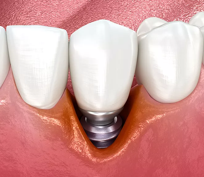 single implant