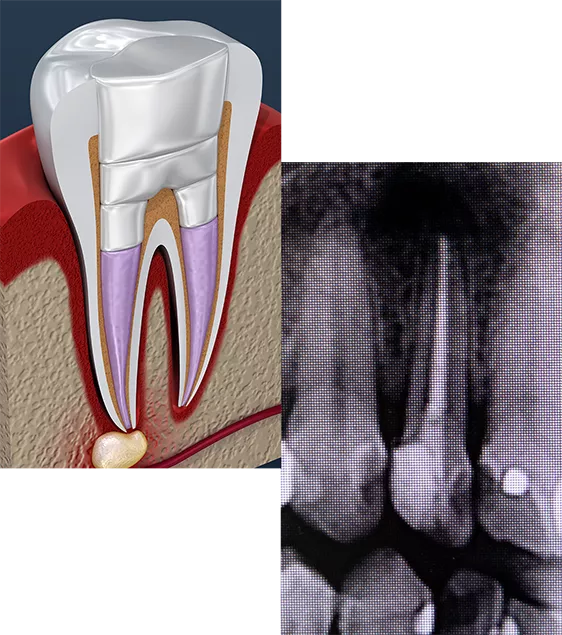 root canal